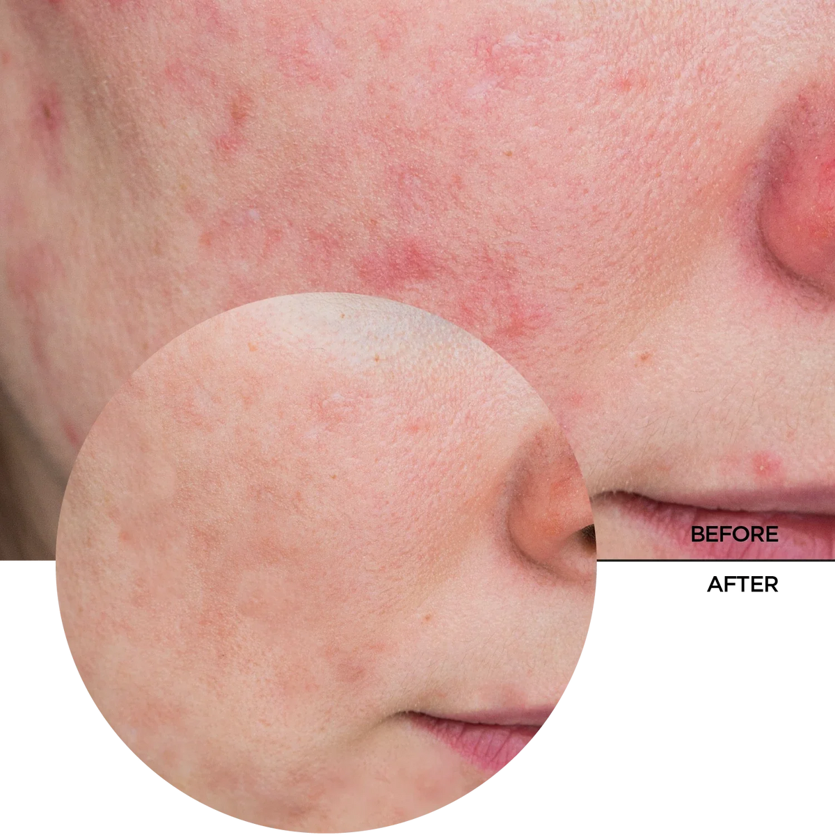 REVOX B77 JUST Azelaic Acid 10% 30ml