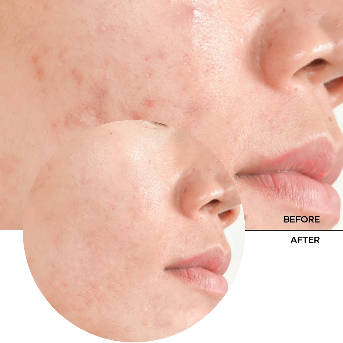 REVOX B77 JUST Salicylic Acid 2% 30ml